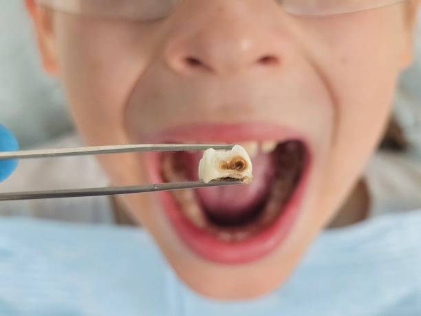 Best Emergency Dental Extractions in Big Sandy, TX
